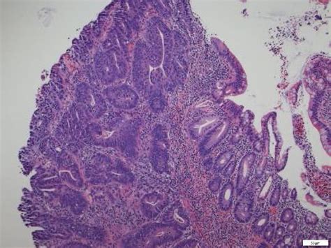 Hande Stain Of Colonic Biopsy Shows Multiple Solid Features Of Malignancy Download Scientific