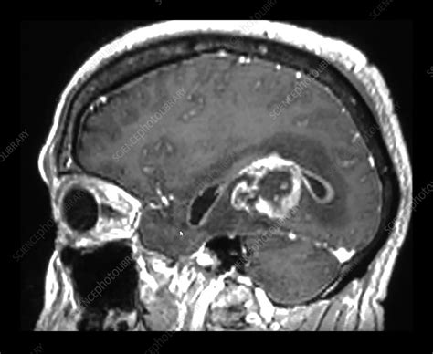 Glioblastoma Mri Stock Image C Science Photo Library