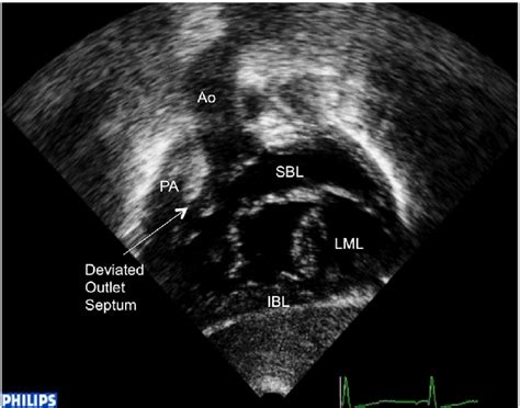 Tof Avsd Subcostal Short Axis Images At The Level Of The Av Valve