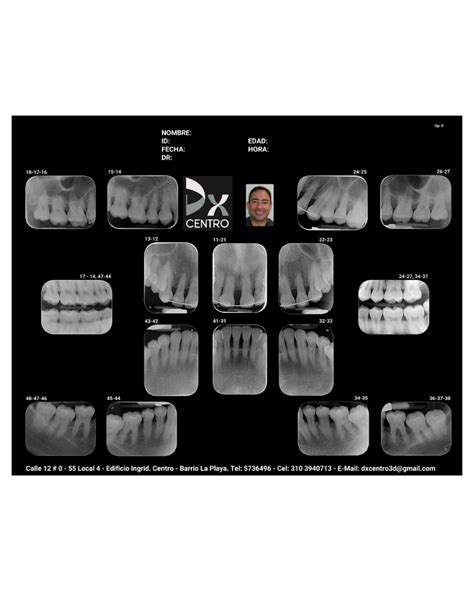 JUEGO PERIAPICAL COMPLETO Dx Diagnostico Dental