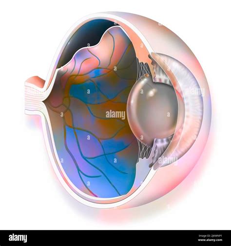 Eye Detachment Of The Retina Which Detaches From The Underlying