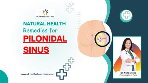 Natural Remedies For Pilonidal Sinus And Alternative Approaches By