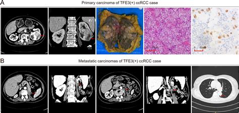 Tfe Gene Rearrangement And Protein Expression Contribute To A Poor