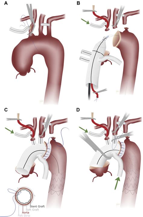 The Buffalo Trunk Technique For Aortic Arch Reconstruction The Annals