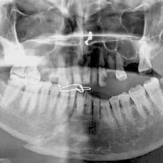 Orthopantomogram Showing Right Parasymphysis Left Angle Fracture And