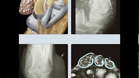 23 SYNOVIAL CHONDROMATOSIS YouTube