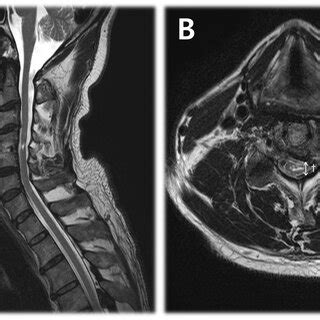 Sagittal A And Axial B Magnetic Resonance Images Of A Year Old