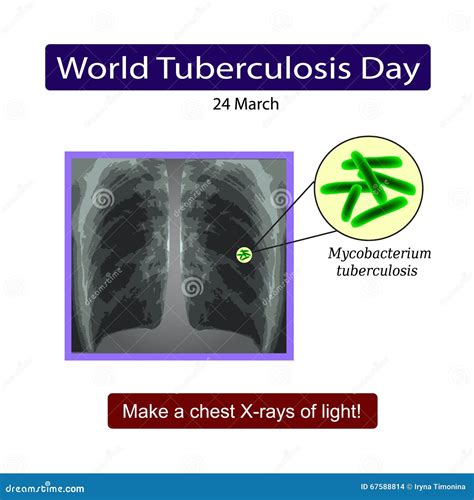 Tuberculosis Tb Infographics Vector Illustration Cartoondealer