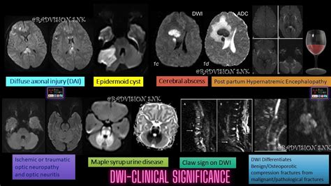 Diffusion Weighted Imaging Dwi Clinical Significance Youtube