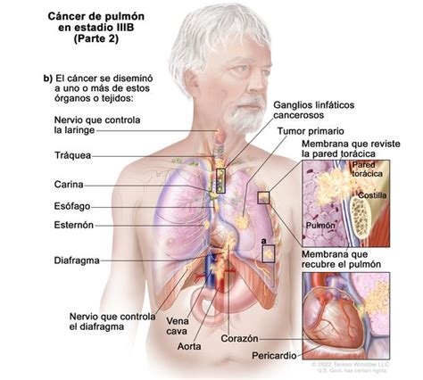 Definici N De C Ncer De Pulm N De C Lulas No Peque As En Estadio Iiib