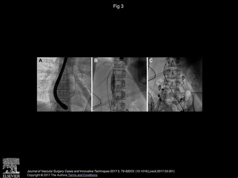 Endovascular Extraction Of A Migrated Large Self Expanding Laser Cut