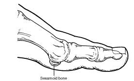 Sesamoid Injuries in the Foot – Sesamoiditis Foot | Foot Health Facts ...