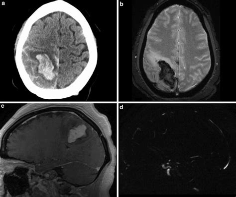 Intracerebral Hemorrhage Mri