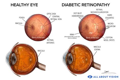 What Is Retinopathy Causes Signs And Symptoms Types And Treatment