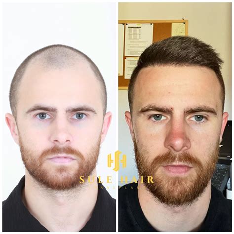 Hair Transplant Turkey Before And After Photos Sule Clinic