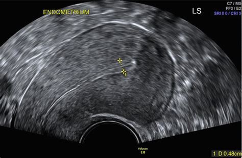 ultrasound evaluation  myometrium obgyn key