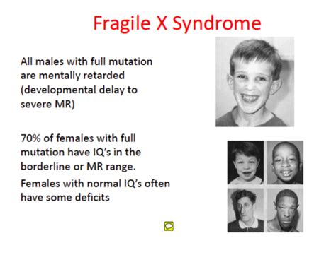 Fragile X Syndrome Testicles