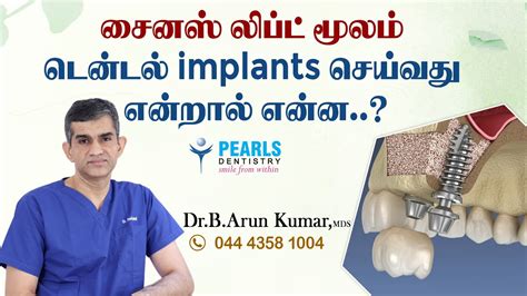 What Is Sinus Lift In Dental Implant Pearls Dentistry Youtube