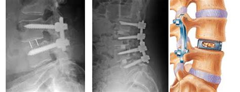 Lumbar Spinal Fusion Tlif Plif