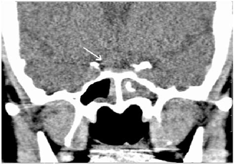 Pdf Isolated Sphenoid Fungal Sinusitis And Coexisting Intrasellar Mass Lesion Presenting With