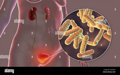 Bakterielle Zystitis Illustration Zystitis Blasenentzündung kann