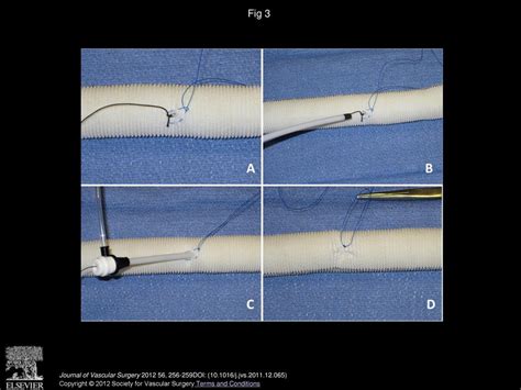 Open Surgical Inferior Vena Cava Filter Retrieval For Caval Perforation