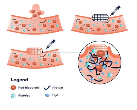 How Do Hemostatic Agents Work