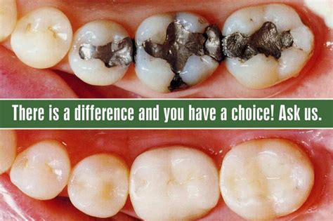 Amalgam Vs Composite Fillings Mckell Packer Dental Provo Dentist