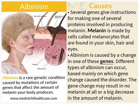 Albinism causes - Medmichihealthcare.com - Medium