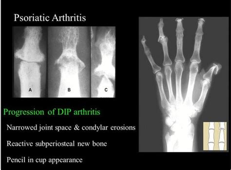 Psoriatic Arthritis Pencil In Cup Psoriatic Arthritis Pencil In Cup