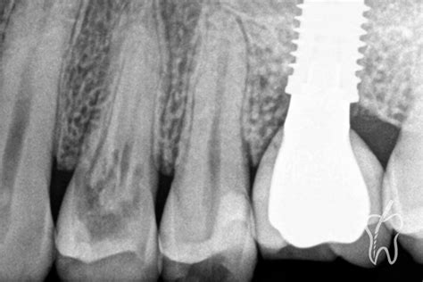 Caso clínico Manejo de una reabsorción cervical invasiva Endogal