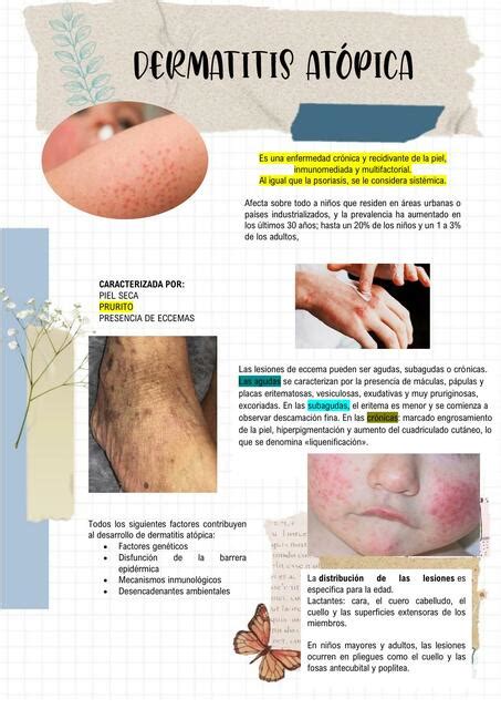 Dermatitis Atópica Alonso Fajardo Canales uDocz