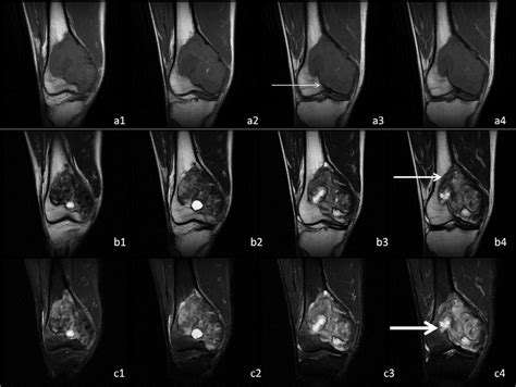 Giant Tumor Of Bone GCTB Located At Distal Femur A1 A4 B1 B4 And