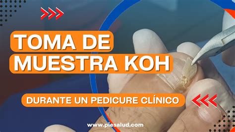 Toma De Muestra Koh Durante Un Pedicure Cl Nico Youtube