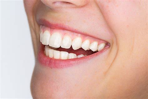 What Causes A Gummy Smile And How Can It Be Corrected Herald Health