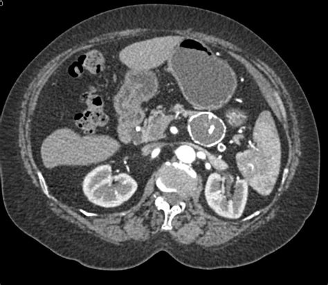 Calcified Splenic Artery Aneurysm Spleen Case Studies Ctisus Ct