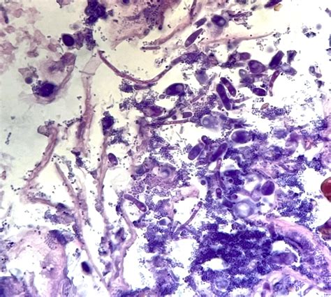 Candida Infection C Albicans In Esophagus Aka Candida Esophagitis