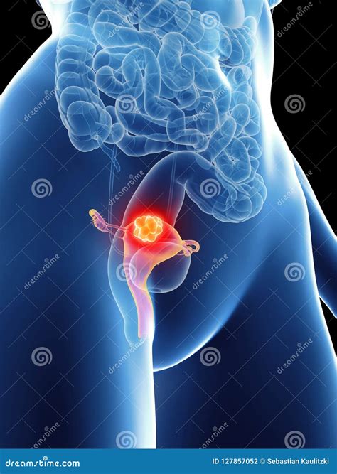 A womans uterus cancer stock illustration. Illustration of biology ...