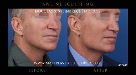 Chiseled Jawline Gallery Male Plastic Surgery Los Angeles