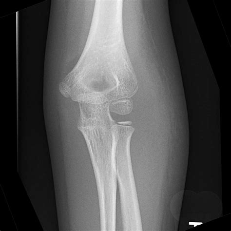 Lateral Condyle Fracture Image