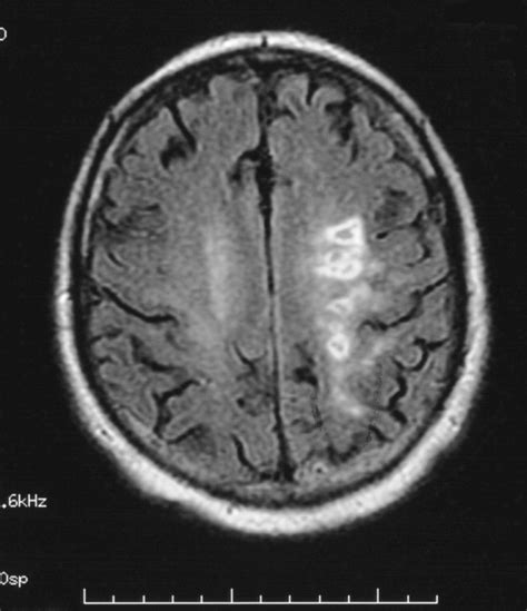 Extracranial Intracranial Bypass In Cerebral Ischemia Ochsner Journal