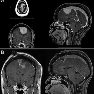 A Axial Coronal And Sagittal Brain Mri With Gadolinium Contrast