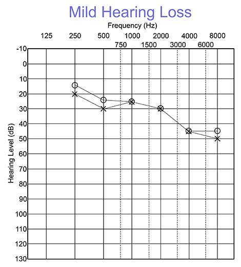 What is an Audiogram? – Understanding Hearing Test Results ...