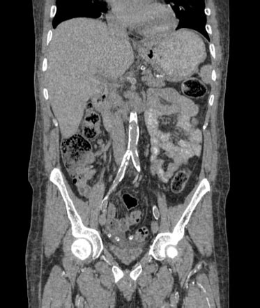 Vascular calcification | Radiology Case | Radiopaedia.org