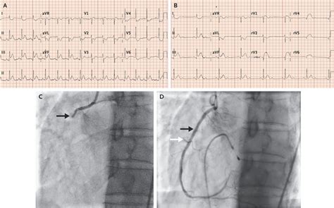 Right Ventricular Infarction NEJM