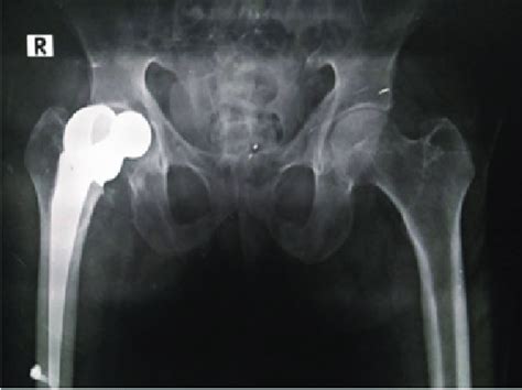 X-ray pelvis AP view showing disassembly of the bipolar prosthesis. | Download Scientific Diagram