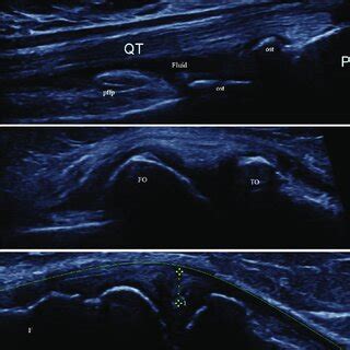 High Frequency Ultrasonographic Evaluation Of Osteoarthritisaffected