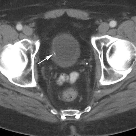 An Axial Portal Venous Phase Contrast Enhanced Ct Image Throught The Download Scientific