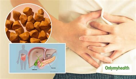 Ways To Prevent Gallstones Naturally Onlymyhealth