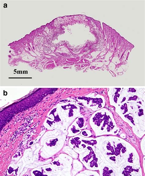 Ab The Definitive Histopathology Showed Small Cellular Nests Of